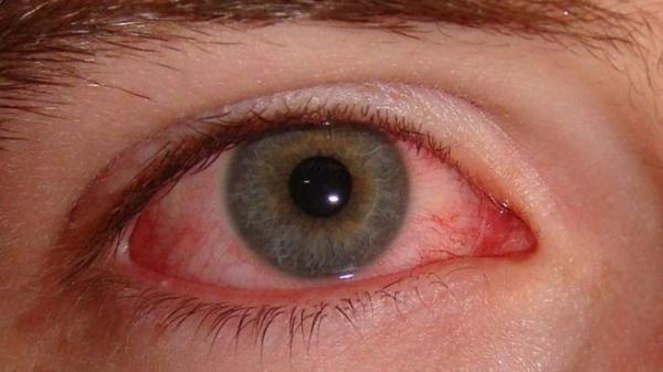 احتمال آلوده شدن سلول‌های چشم به کرونا
