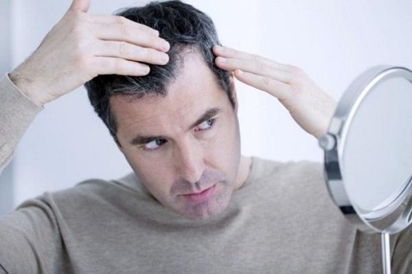 ریزش موی ناشی از ویروس کرونا,ریزش مو بر اثر کرونا