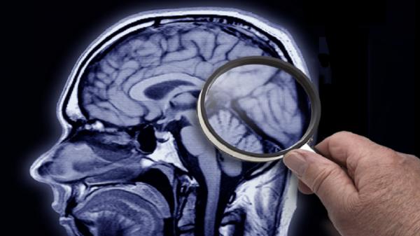 کشفی غیرمنتظره در مغز متوفیان مبتلا به آلزایمر,مس و آهن در مغز متوفیان آلزایمری