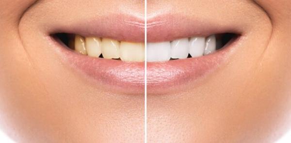 تاثیر مخرب محصولات سفید کننده بر دندان‌ها,تاثیر محصولات سفید کننده بر دندان