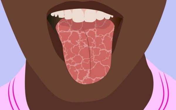 خشکی دهان,تاثیر میزان قند خون در ایجاد خشکی دهان