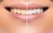 تاثیر مخرب محصولات سفید کننده بر دندان‌ها,تاثیر محصولات سفید کننده بر دندان