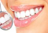 دندان,آثار مخرب سفید کردن دندان