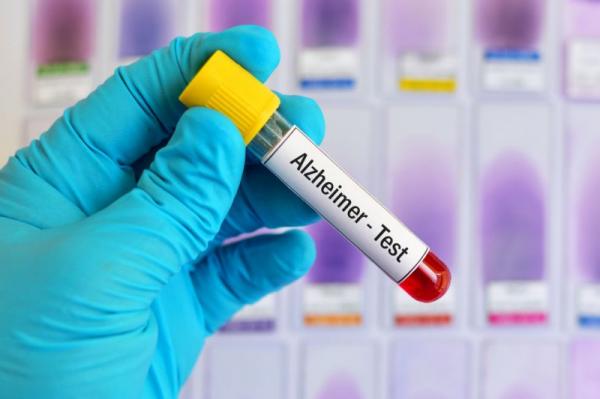 آلزایمر,آزمایش خون جدید برای تشخیص آلزایمر