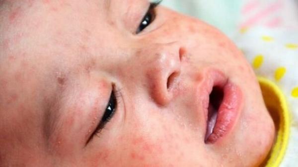 آخرین وضعیت شیوع سرخک در کشور,واکسن سرخک کودکان