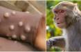 بیماری آبله میمون,بیماری جدید