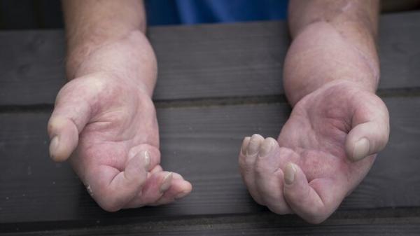 پیوند دست,اولین پیوند هر دو دست در جهان در یک فرد مبتلا به اسکلرودرمی