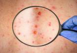 شناسایی موارد بیشتری از آبله میمون,آبله میمون
