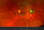 کشف یک بیماری ژنتیکی جدید در چشم,بیماری چشمی