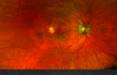 کشف یک بیماری ژنتیکی جدید در چشم,بیماری چشمی