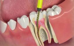 دندان,عصب کشی دندان