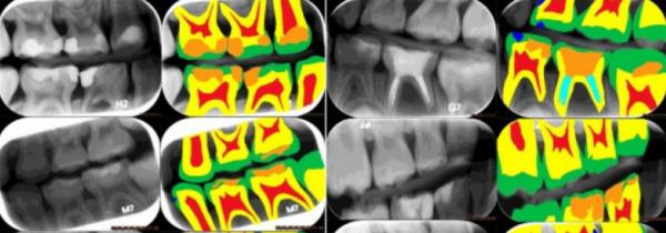 پوسیدگی دندان,تشخیص پوسیدگی دندان با پشتیبانی هوش مصنوعی