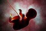 سقط جنین,سلب اختیار سقط جنین ناسالم از پزشکان