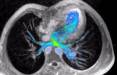 تشخیص نارسایی عروق خونی قلب,MRI چهاربعدی برای تشخیص نارسایی قلبی