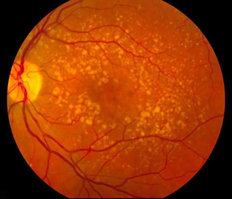 تخریب لکه زرد چشم,شناسایی ژنی مرتبط با بیماری تخریب ماکولای چشم