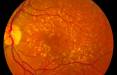 تخریب لکه زرد چشم,شناسایی ژنی مرتبط با بیماری تخریب ماکولای چشم