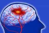 سکته مغزی,فناوری جدید برای رصد احتمال سکته مغزی