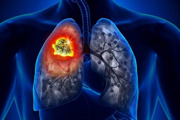 سرطان ریه,افزایش ریسک ابتلا به سرطان ریه با اختلال در ریتم شبانه روزی بدن