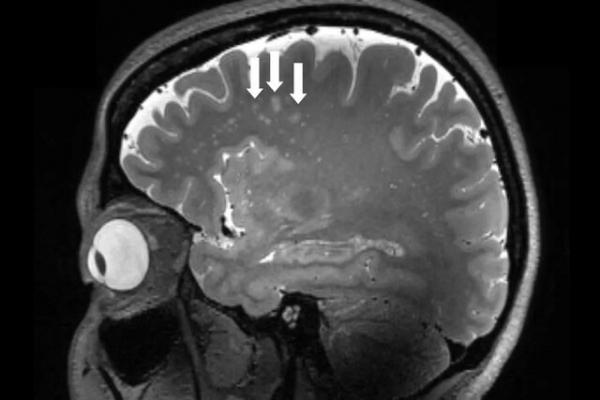 مغز,انتشار اولین تصاویر از میگرن در مغز