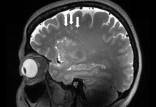 مغز,انتشار اولین تصاویر از میگرن در مغز