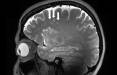 مغز,انتشار اولین تصاویر از میگرن در مغز
