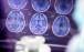 درمان آلزایمر,درمان آلزایمر با کشف دو ژن جدید