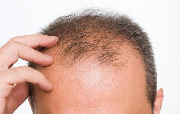 ریزش مو,عامل تشدید کننده ریزش مو درمردان