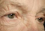 بیماری چشمی دژنراسیون ماکولا,نابینایی غیرقابل برگشت