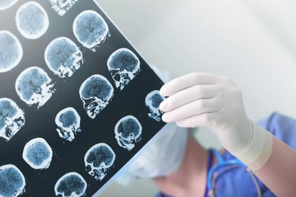 افزایش دو برابری خطر مرگ زودهنگام با ضربه خوردن به سر,مرگ بر اثر ضربه مغزی