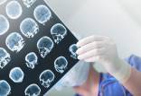 افزایش دو برابری خطر مرگ زودهنگام با ضربه خوردن به سر,مرگ بر اثر ضربه مغزی
