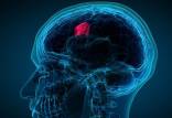 سرطان مغز,آسیب به سر منجر به ابتلا به سرطان مغز