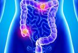سرطان روده,شناسایی علائم اولیه جدید سرطان روده