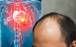 موی سر,تشخیص احتمال خطر ابتلا به حمله قلبی با هورمون های استرس موجود در مو