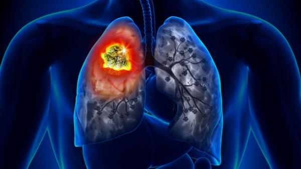 سرطان ریه,کاهش خطر مرگ بیماران مبتلا به سرطان ریه با قرص Osimertinib