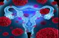 سرطان تخمدان,زنان مبتلا به سندرم تخمدان پلی کیستیک در خطر ابتلا به سرطان تخمدان