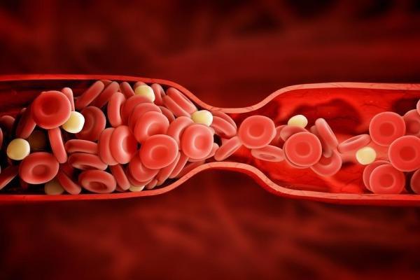 پلاک خونی,کمتر شدن ریسک حمله قلبی با کاهش پلاک های خونی