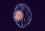 سرطان مغز,کشف یک دارو موثر برای درمان سرطان مغز