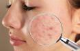 درمان جوش صورت,کشف مولکولی برای درمان جوش صورت