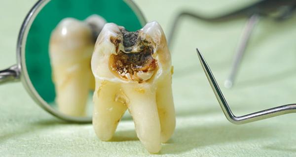 پوسیدگی دندان‌ها,کشف مولکولی برای جلوگیری از پوسیدگی دندان‌ها