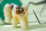 پوسیدگی دندان‌ها,کشف مولکولی برای جلوگیری از پوسیدگی دندان‌ها
