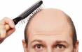 ریزش مو,شناسایی ژن‌های نادر عامل ریزش موی مردان