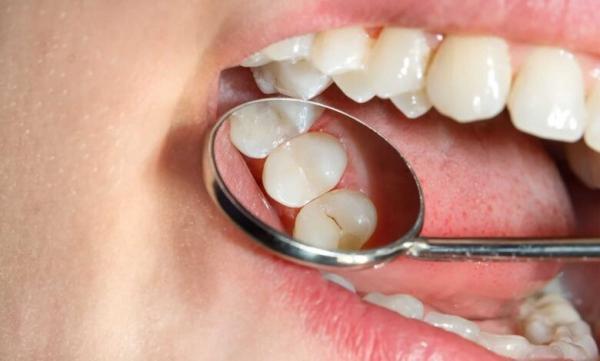 دندان خراب,وضعیت عجیب دندان های مردم ایران