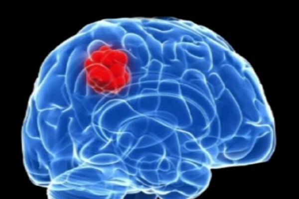 یک داروی موثر در درمان سرطان مغز,دارو برای سرطان مغز