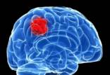 یک داروی موثر در درمان سرطان مغز,دارو برای سرطان مغز