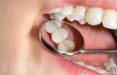 دندان خراب,وضعیت عجیب دندان های مردم ایران