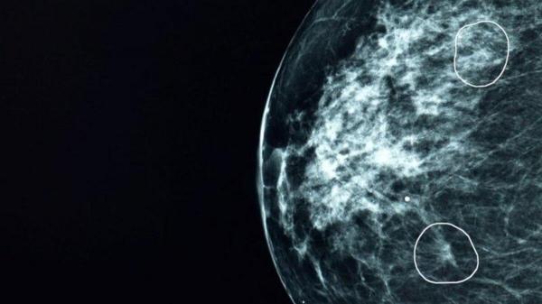 هوش مصنوعی,تشخیص سرطان پستان با هوش مصنوعی