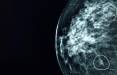 هوش مصنوعی,تشخیص سرطان پستان با هوش مصنوعی