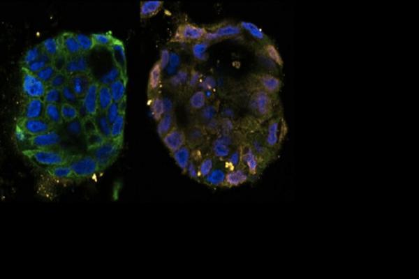 مرگ سلول‌های سرطانی,ژن Schlafen11, فرآیند مرگ سلول‌ها