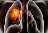 سرطان,موفقیت قرص جدید سرطان ریه در آزمایش‌های بالینی