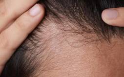 ریزش مو,درمانی جدید برای ریزش مو
